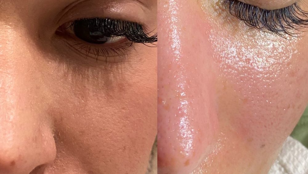 Unlock Youthful Glass Skin at MT Skin Clinic in Beverly Hills