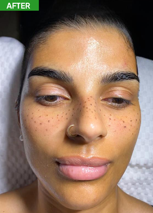 After Acne Facial